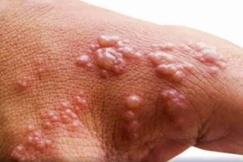 Delhi govt directs 3 private hospitals to create isolation rooms for monkeypox