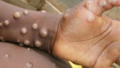 12-yr-old K'taka girl develops monkeypox symptoms