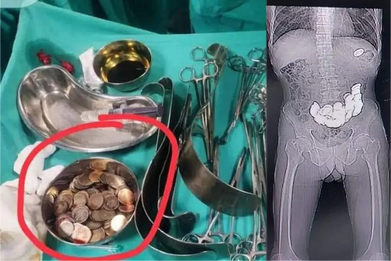 Doctors remove 187 coins from man’s stomach; know why he had swallowed them