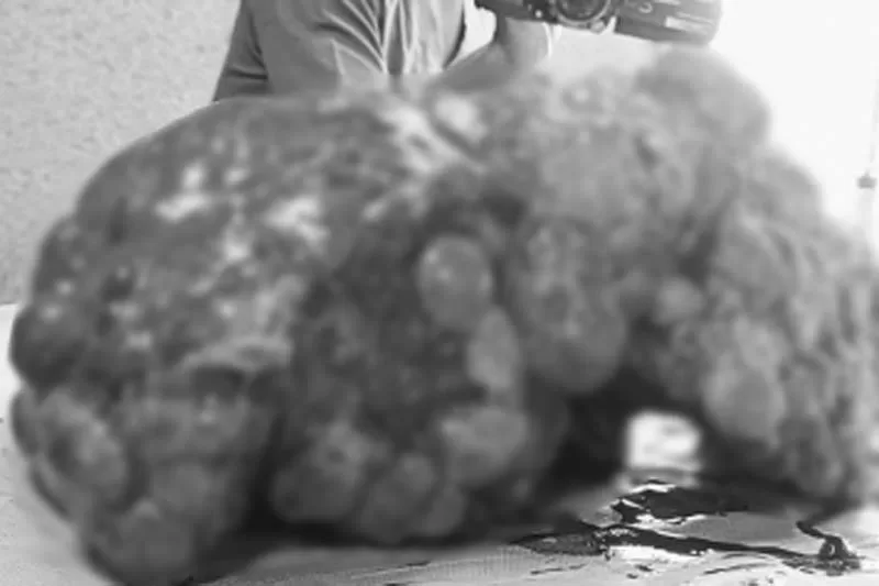 Doctors at Hyderabad hospital remove 12 kg liver from woman