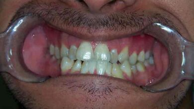 Maxillary Jaw Replacement Surgery performed at Military Hospital Secunderabad