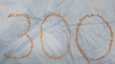 300 kidney stones removed from 75-yr-old farmer at Hyderabad's AINU