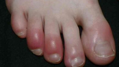Swelling in feet could be signs of kidney trouble