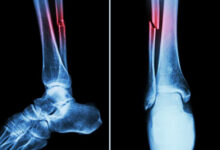 Covid can cause bone loss, higher fracture risk: Study