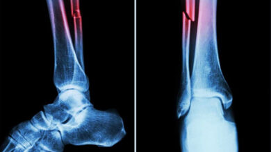 Covid can cause bone loss, higher fracture risk: Study