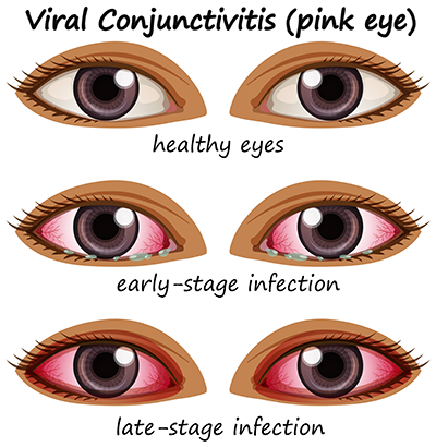 Symptoms of Pink Eye Pink Eye Outbreak in Hyderabad, Telangana: Symptoms, Preventions & More!