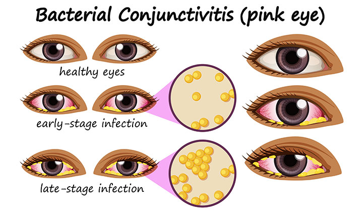 What is Pink Eye Conjunctivitis Pink Eye Outbreak in Hyderabad, Telangana: Symptoms, Preventions & More!