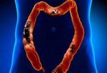 Study shows how stress worsens colorectal cancer