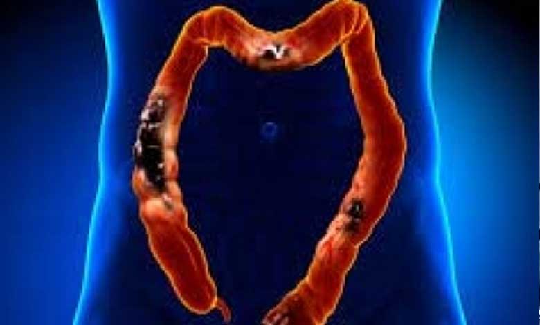 Study shows how stress worsens colorectal cancer