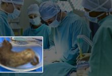 2kg human hair found in woman's stomach