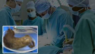 2kg human hair found in woman's stomach