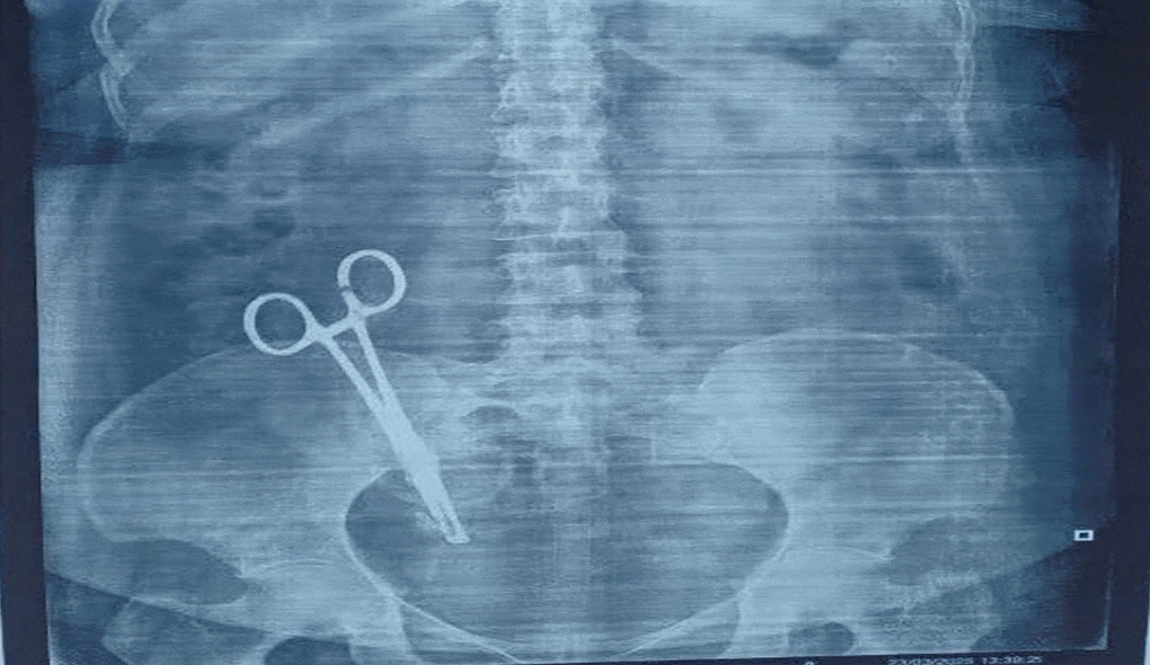 Viral: Woman Suffers from Stomach Pain for 17 Years, X-Ray Reveals Shocking Truth