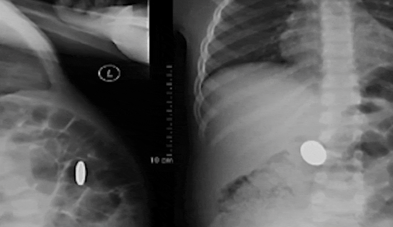 Stomach Pain and Unusual Movements Lead to Discovery of Coin in Woman’s Stomach
