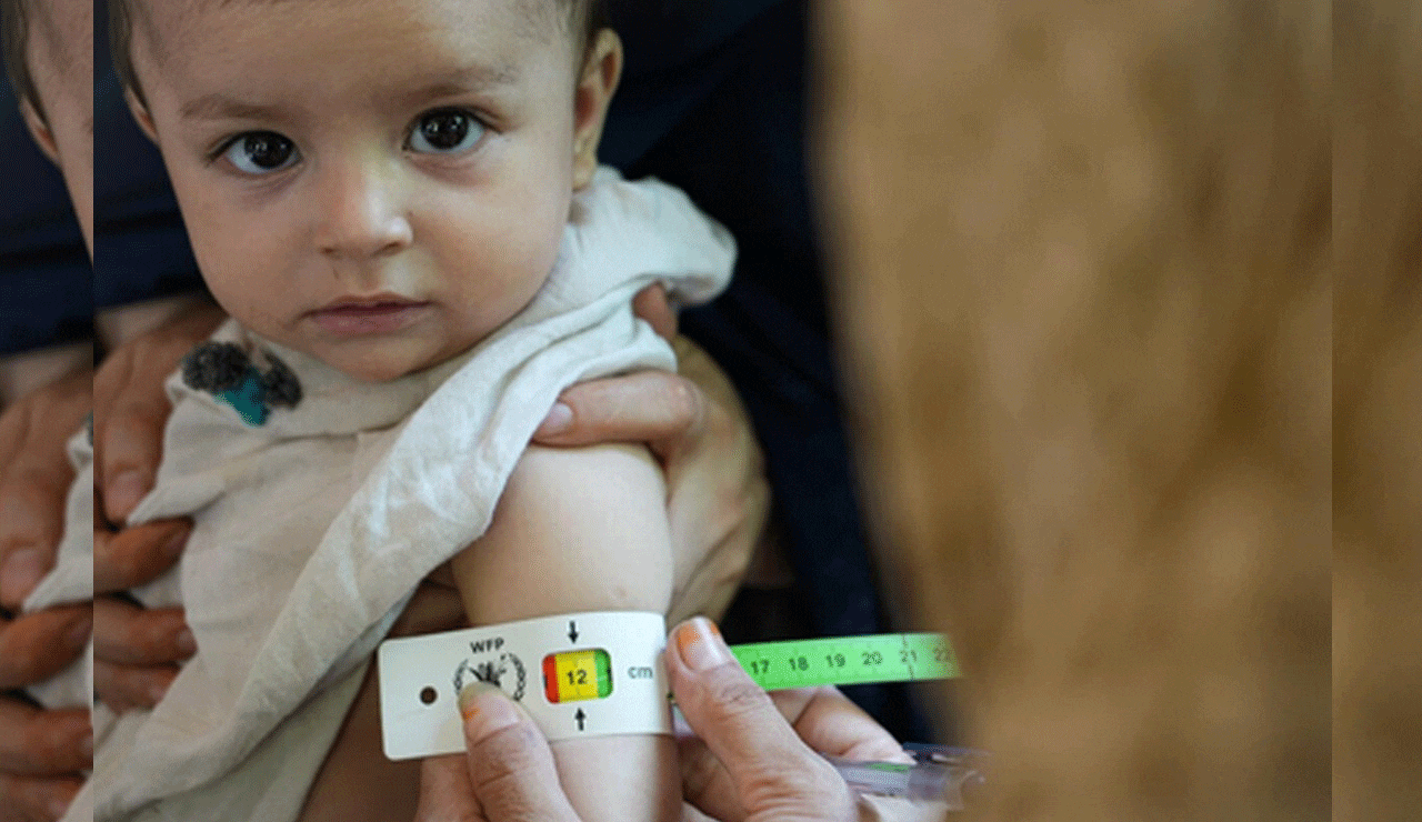 UN Urges Immediate Action as 3.5 million Afghan Kids Face Malnutrition Threat