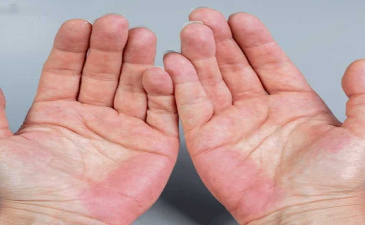 Fatty Liver Disease: 5 Early Warning Signs That Show Up on Your Hands
