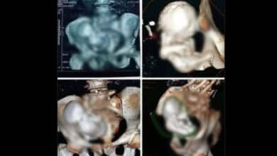 Viral Shock: 30-Year-Old Foetus Found in 73-Year-Old Woman? Social Media Divided