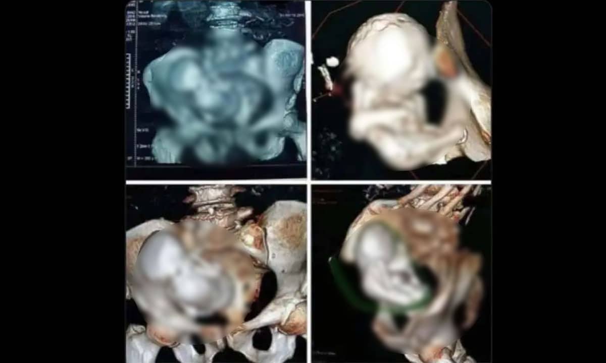 Viral Shock: 30-Year-Old Foetus Found in 73-Year-Old Woman? Social Media Divided