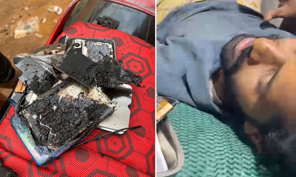 Hyderabad: Vivo Phone Catches Fire in Attapur, Youth Suffers Severe Burns