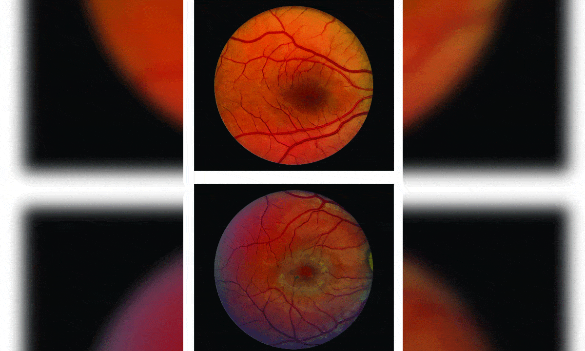 Surgical implant can slow down vision loss caused by blinding eye disease: Study
