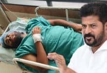 Telangana Chief Minister Revanth Reddy Gives Life to Accident Victim by Providing Artificial Legs