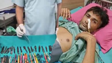 Surgical team at Dev Nandini Hospital successfully removed 50 foreign objects from a patient's stomach in a complex procedure.