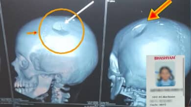 Sixth Class Girl Suffers Skull Fracture After Teacher Beats Her