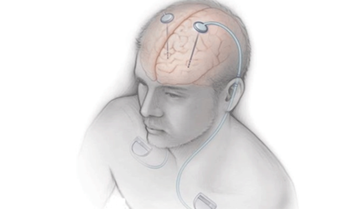 AIIMS conducts India’s 1st Deep Brain Stimulation workshop for Parkinson’s, movement disorders