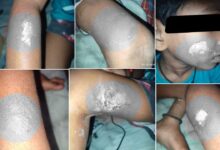Hyderabad Shocker, Tuition Teacher Burns 7-Year-Old Boy with Hot Ladle in OU Colony