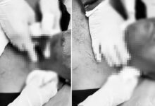 Deadly Chinese Manja Strikes Again in Hyderabad, Man’s Throat Severely Injured