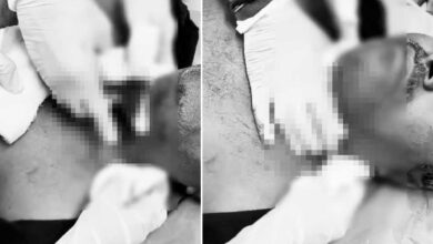 Deadly Chinese Manja Strikes Again in Hyderabad, Man’s Throat Severely Injured