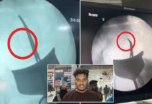 Surgical Needle Left Inside Woman’s Abdomen After C-Section at Suleman Nagar Hospital, Condition Critical