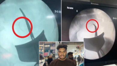 Surgical Needle Left Inside Woman’s Abdomen After C-Section at Suleman Nagar Hospital, Condition Critical