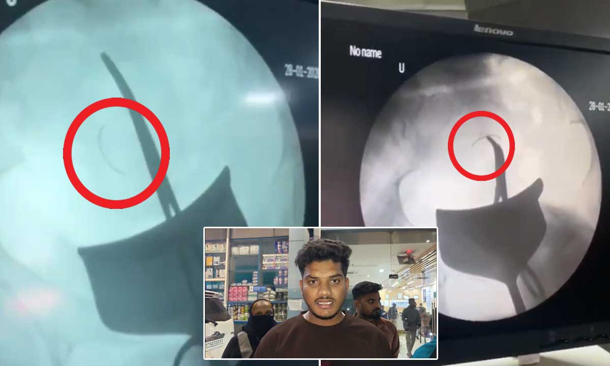 Surgical Needle Left Inside Woman’s Abdomen After C-Section at Suleman Nagar Hospital, Condition Critical