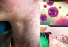 Mongolia sees surge in measles cases