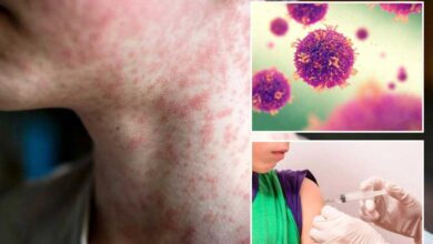 Mongolia sees surge in measles cases