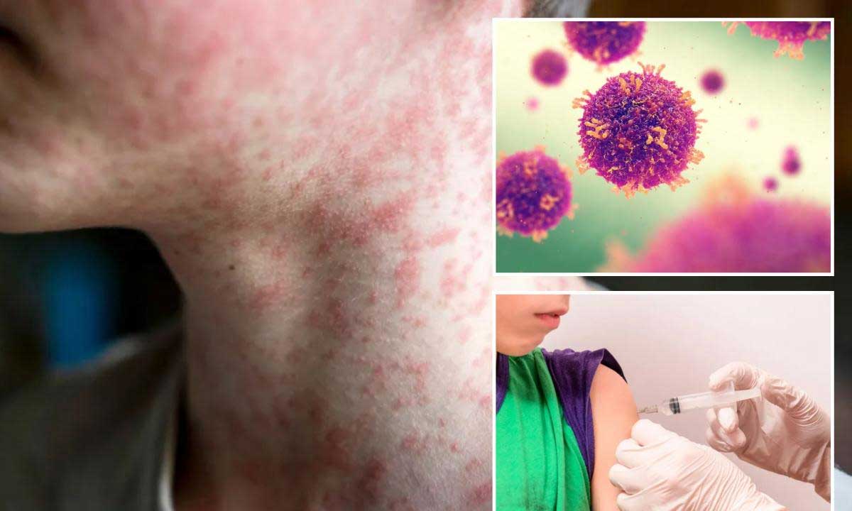 Mongolia sees surge in measles cases