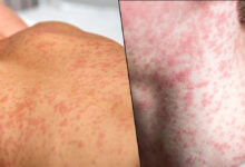 US reports over 2,000 measles cases in 2025, highest since 1992