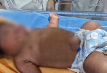 Woman Delivers 5.2 Kg Baby at Bhadrachalam Area Hospital in Telangana