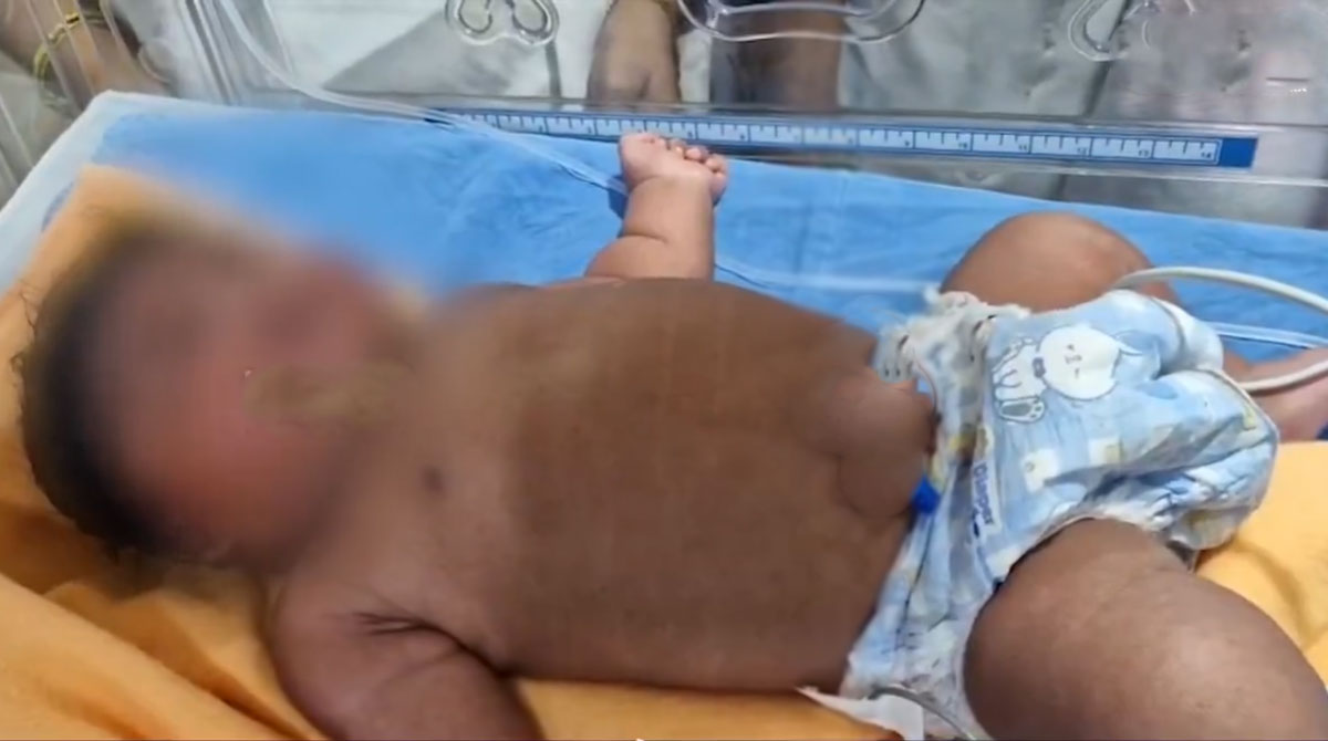 Woman Delivers 5.2 Kg Baby at Bhadrachalam Area Hospital in Telangana