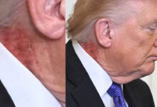 Red Mark on Donald Trump’s Neck Sparks Health Debate After Public Appearance