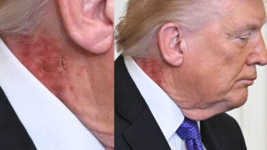 Red Mark on Donald Trump’s Neck Sparks Health Debate After Public Appearance