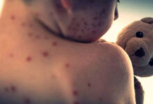 Measles claims lives of 71 children in Pakistan in four months of 2026