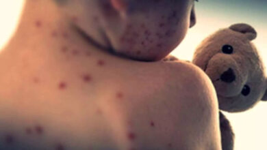 Measles claims lives of 71 children in Pakistan in four months of 2026