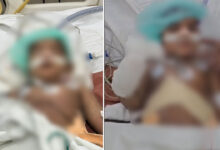 Hyderabad Milestone: 18-Month-Old Child Undergoes 14-Hour Liver Transplant at Osmania General Hospital