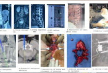 Rare Spinal Cancer in 10-Year-Old Treated Successfully at KIMS Kondapur