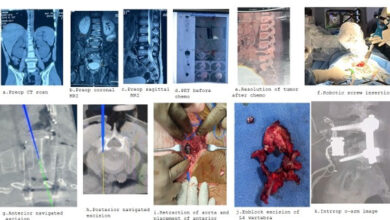 Rare Spinal Cancer in 10-Year-Old Treated Successfully at KIMS Kondapur
