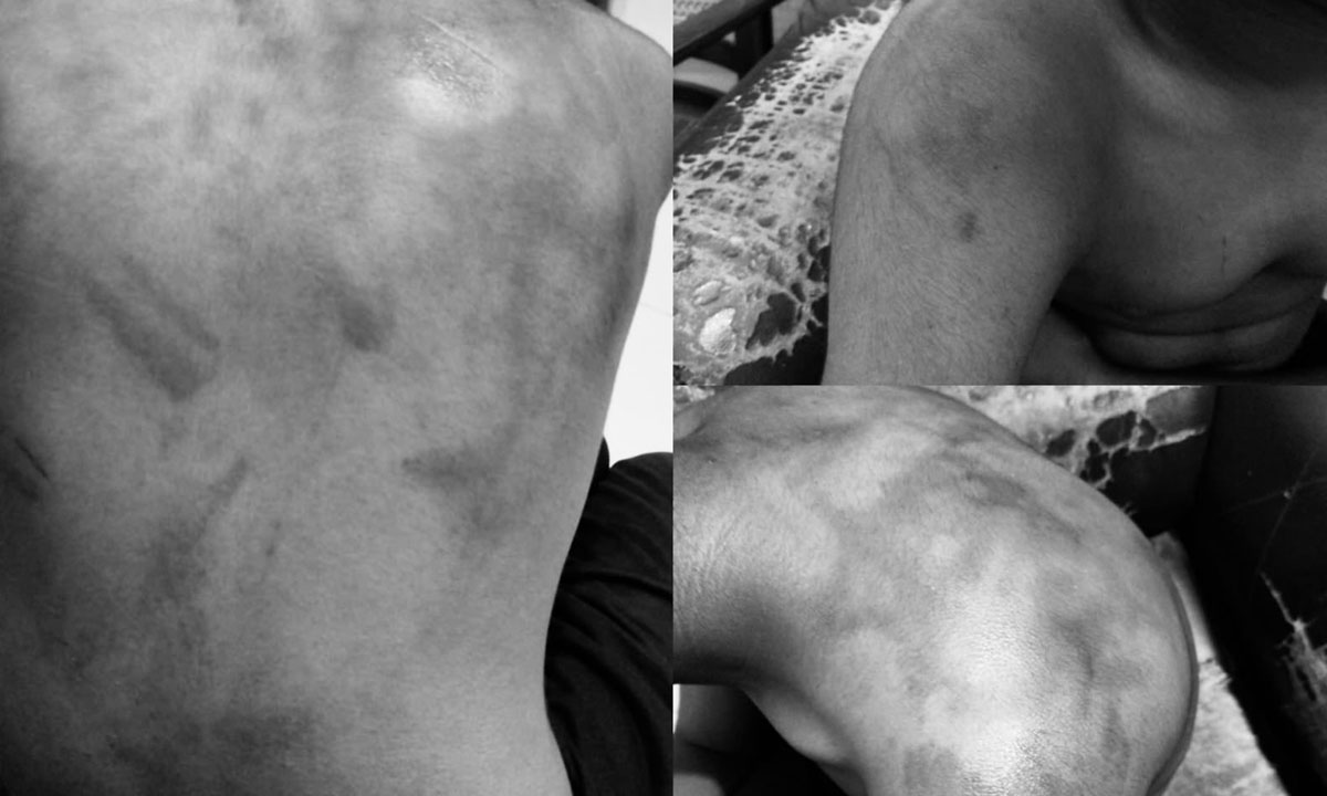 Class 10 Student Allegedly Brutally Assaulted at Sri Chaitanya Hostel, Critical