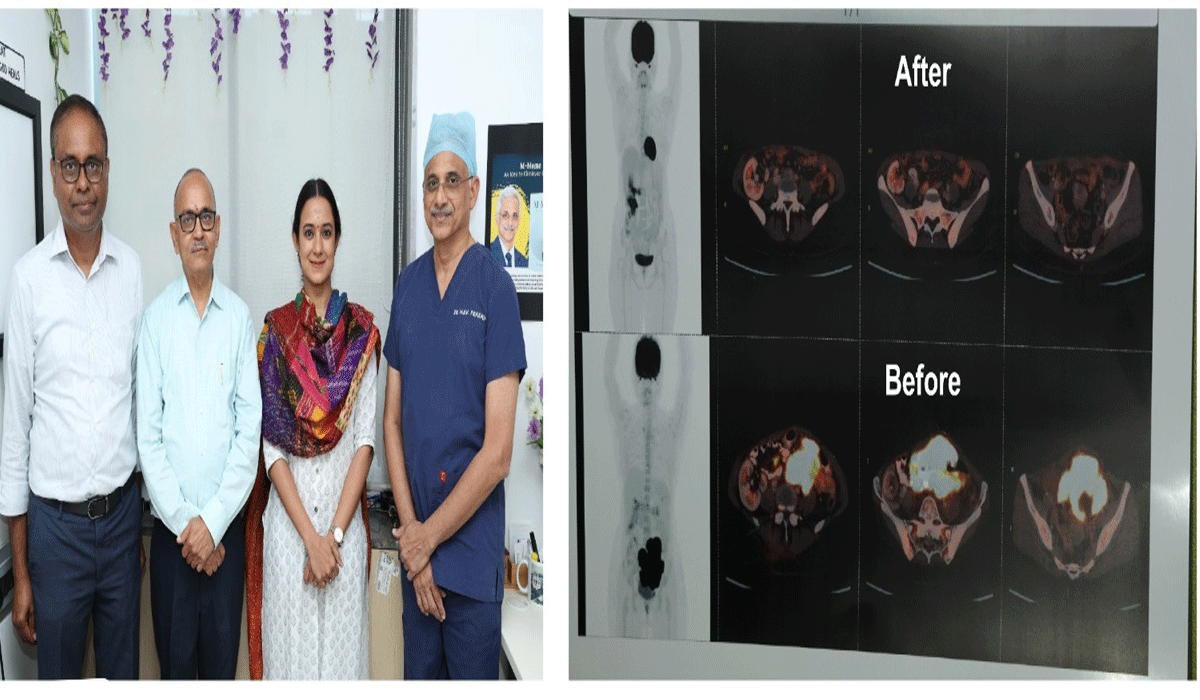 Hyderabad: KIMS Doctors Successfully Treat Cancer in Woman with 17-Year-Old Kidney Transplant